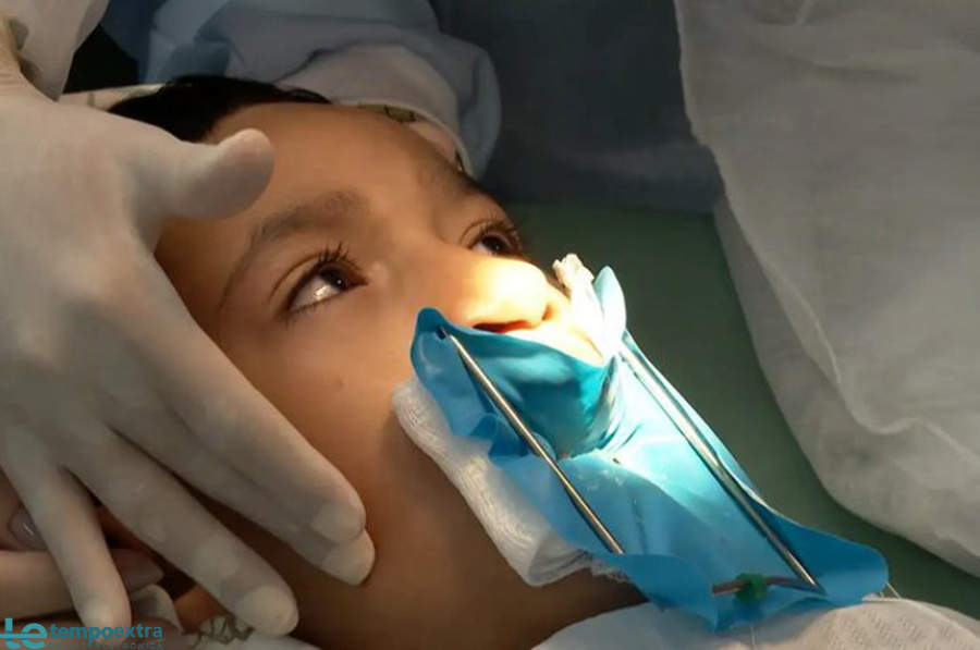 Tratamento completo para lábio leporino passa a ser garantido pelo SUS com nova lei